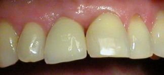 Implant with crown (left-on the picture - from the middle line)