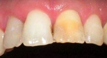 Discolored tooth