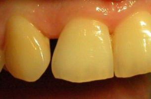 Diastema what patient can not accept