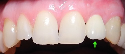 Implant with crown