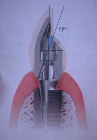Implant with crown in the bone