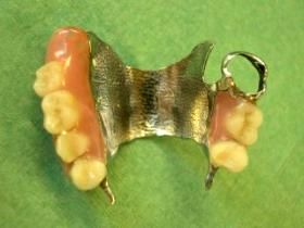 Upper partial denture